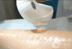 腿毛很多的原因是什么？激光脫毛有哪些注意事項(xiàng)？
