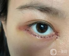 外切眼袋外翻恢復(fù)需要多長時(shí)間？為什么會出現(xiàn)這種情況？