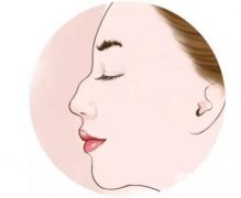 駝峰鼻整形要多少錢(qián)？手術(shù)方法有哪些？