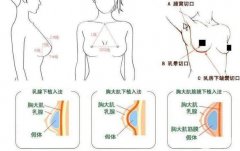 乳房整形前后！手術(shù)后遺癥及處理措施一覽