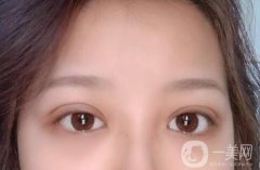 開眼角會留下疤痕嗎?開眼角手術(shù)后多久能康復(fù)？