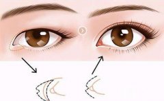 開眼角會不會影響視力，開眼角會有害嗎？