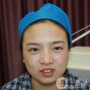 激光祛斑后間隔多久可以化妝，激光去斑的優(yōu)缺點