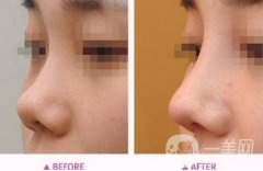 假體隆鼻能持續(xù)多長時間，假體隆鼻怎么樣?