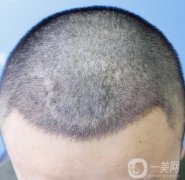 植發(fā)的一般價格是多少?頭發(fā)稀疏可以植發(fā)嗎?