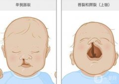 唇腭裂修復(fù)術(shù)有哪些并發(fā)癥？唇腭裂手術(shù)后需要注意什么？