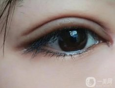 割完雙眼皮多少錢啊?割雙眼皮有哪些方法?