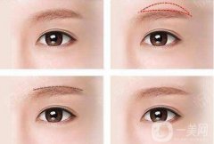 切眉可以熬夜嗎，切眉熬夜有什么不好的的影響?