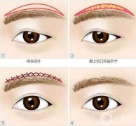 切眉和提眉哪個(gè)更好，切眉相關(guān)手術(shù)介紹
