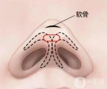 鼻尖整形多少錢？有哪些因素影響？