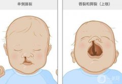 兔唇必須要修復(fù)嗎？怎么修復(fù)兔唇？