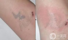 紋身后可以吃羊肉嗎？紋身后可以多久運(yùn)動(dòng)呢？