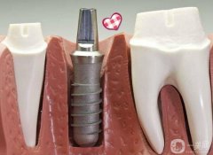 種植牙疼嗎?種牙的痛苦持續(xù)多久?