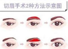 切眉術會產(chǎn)生疤痕嗎?