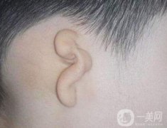 小耳畸形的矯正一般持續(xù)多長時間?