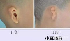 造成小耳畸形的原因有哪些?