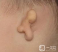 小耳畸形矯正需要多少錢?和哪些的因素有關系呢?