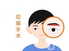 切眉術(shù)能持續(xù)多久?