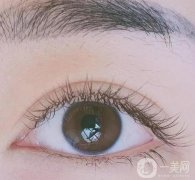 雙眼皮手術(shù)失敗的幾種表現(xiàn)及修復(fù)方法!