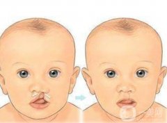 唇腭裂術(shù)后畸形修復(fù)果如何?