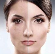 激光美膚有哪些類型?激光美膚手術(shù)后的注意事項(xiàng)有哪些?