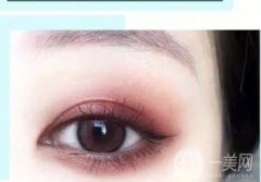 割雙眼皮可以修復(fù)嗎?雙眼皮切開后的注意事項(xiàng)