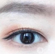 雙眼皮割寬了可以修嗎?雙眼皮修復(fù)后注意事項(xiàng)?