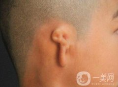 先天性小耳畸形的原因是什么?先天性小耳畸形應該怎么調節(jié)?