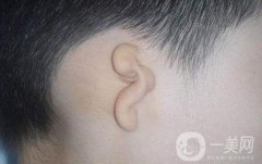先天性小耳畸形需要調節(jié)嗎?