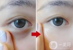 激光去除黑眼圈會不會反彈？果能維持多久？