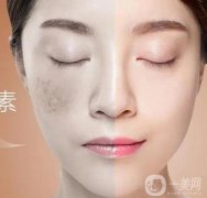 激光祛斑后吃什么可以恢復(fù)較快呢？