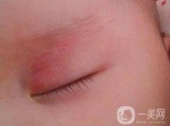 什么是鮮紅斑痣?如何用激光調(diào)節(jié)鮮紅斑痣?