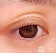 如果雙眼皮變成了三眼皮該怎么辦?