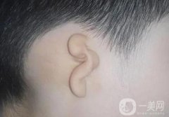 小耳畸形再造的方法有哪些?