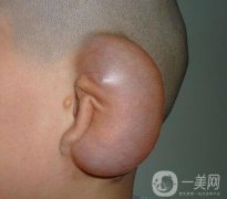 為什么小耳畸形很難重塑?