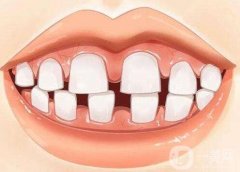 牙縫大能做哪些矯正?牙縫過大的原因?