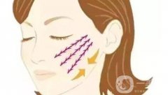 電波拉皮的優(yōu)勢!電波拉皮能持續(xù)多久?