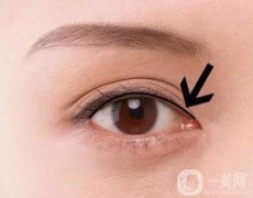 紋美瞳線會(huì)不會(huì)掉睫毛呢?紋瞳孔線掉睫毛應(yīng)該怎么辦?