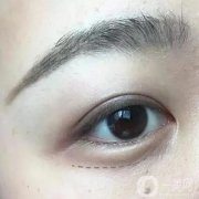 臥蠶可以去掉嗎？如何去掉？