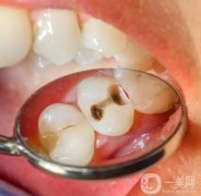 補牙洞需要打麻藥嗎？