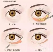 超聲波去眼袋有哪些危害？