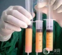 抽脂有危險(xiǎn)嗎？有哪些危害？