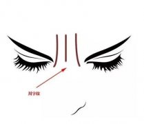 川字紋能手術去除嗎？川字紋形成的原因？