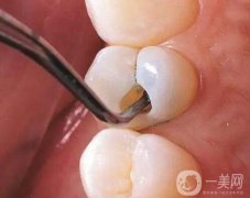 補(bǔ)牙洞需要做多少次？