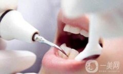 超聲波潔牙可以去除黃牙嗎？