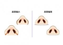 鼻翼縮小手術需要多久？什么時候可以拆線？