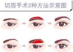 切眉留下的疤痕如何消除?