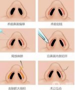 鼻翼內(nèi)切的果是不是*性的?