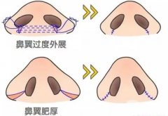 鼻翼內(nèi)切會增生嗎，內(nèi)切有什么注意事項?