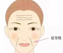 用什么玻尿酸來填充法令紋？